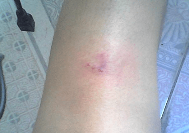 贵宾犬咬出血要打针吗？建议要这样处理下